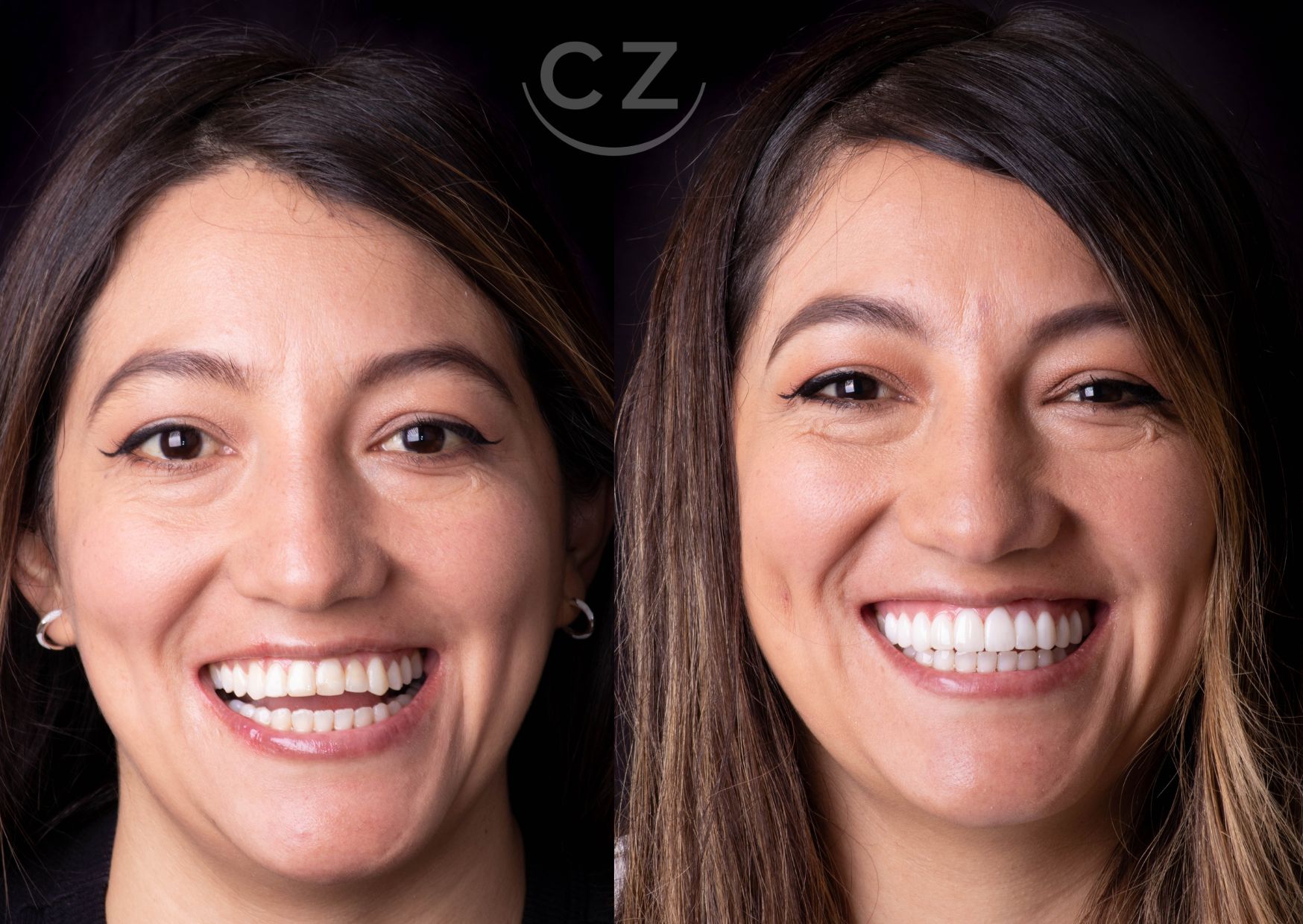 Precio del diseño de sonrisa en Quito