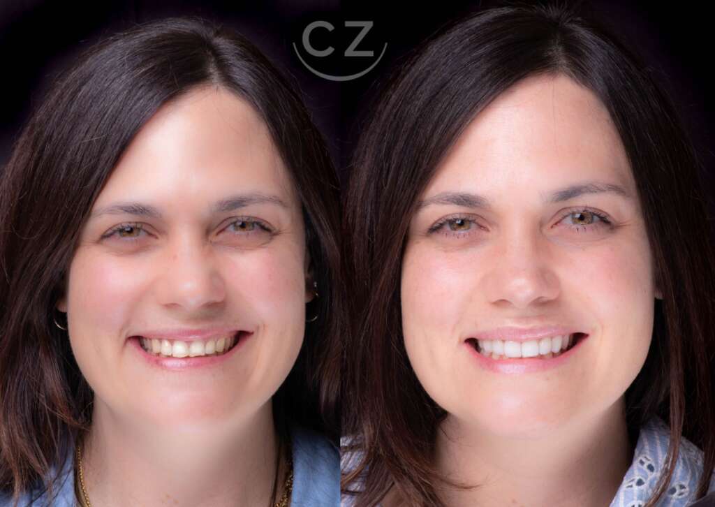 Costo de un diseño de sonrisa Quito