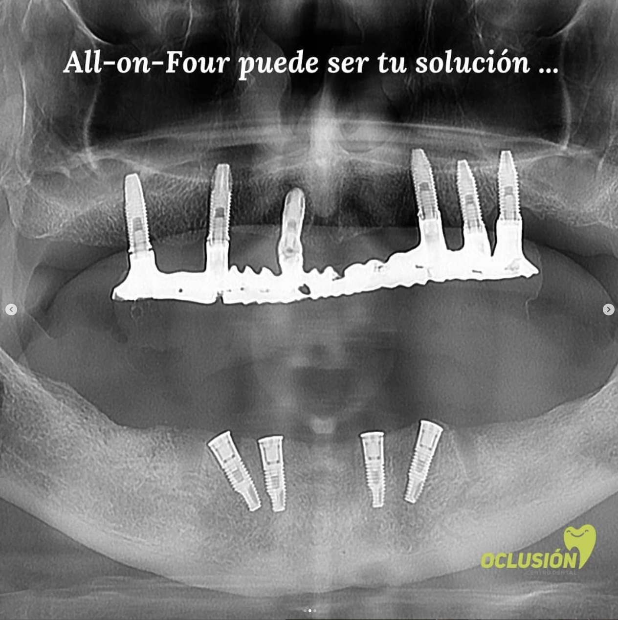 All-on-four-Xrays-Dra-Cecilia-Zambrano